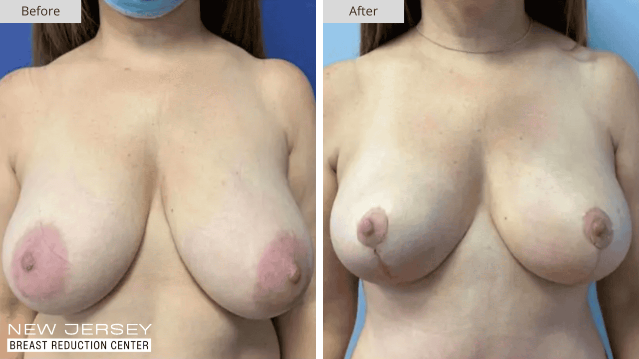 Breast Reduction New Jersey Before and After Patient #1 Front