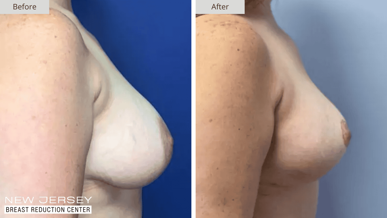 Breast Reduction New Jersey Before and After Patient #1 Side