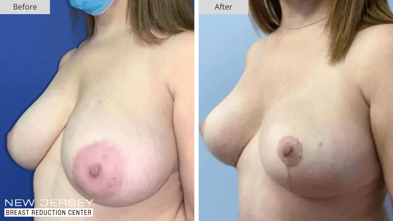 Breast Reduction New Jersey Before and After Patient #1