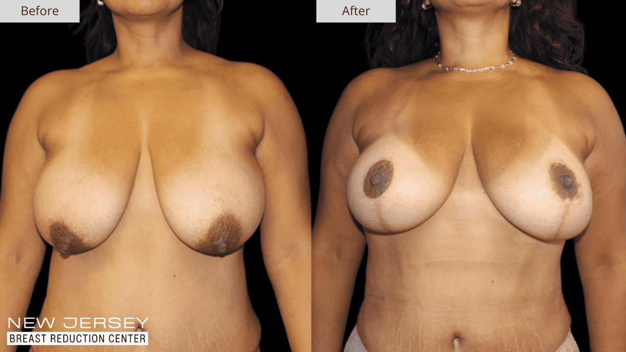 Breast Reduction New Jersey Before and After Patient #2 Front