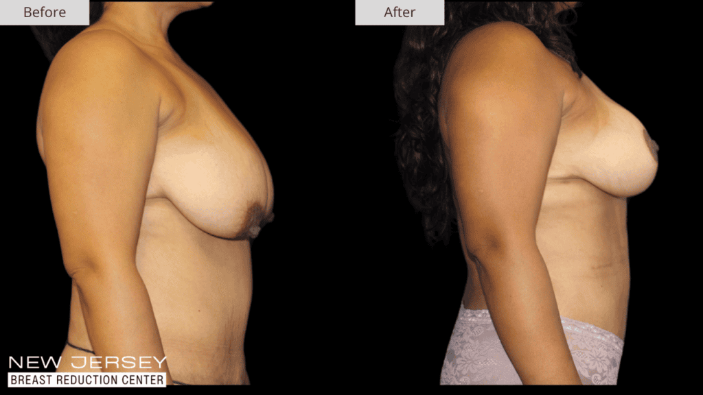 Breast Reduction New Jersey Before and After Patient #2 Side