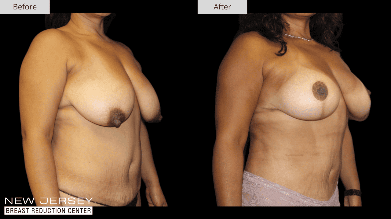 Breast Reduction New Jersey Before and After Patient #2
