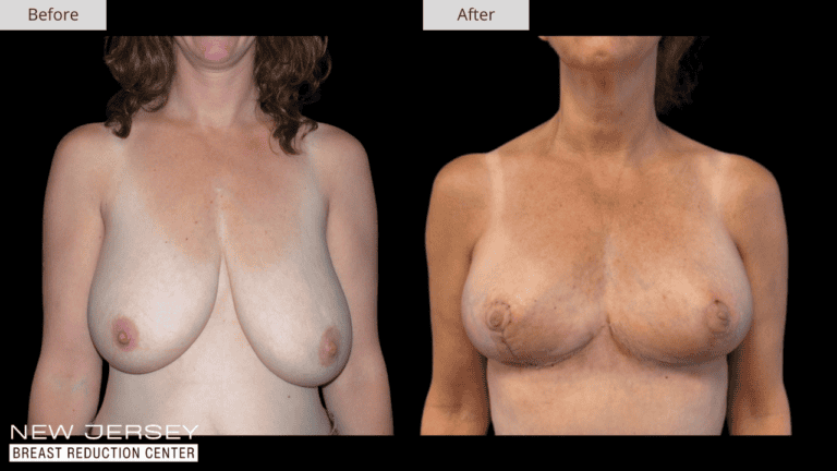 Breast Reduction New Jersey Before and After Patient #3 Front