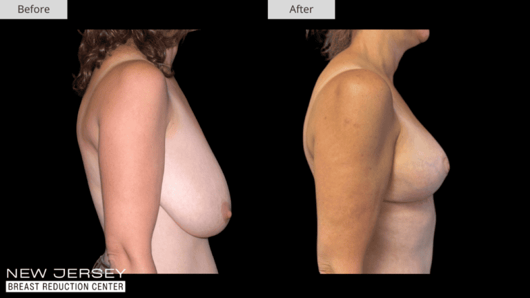 Breast Reduction New Jersey Before and After Patient #3 Side