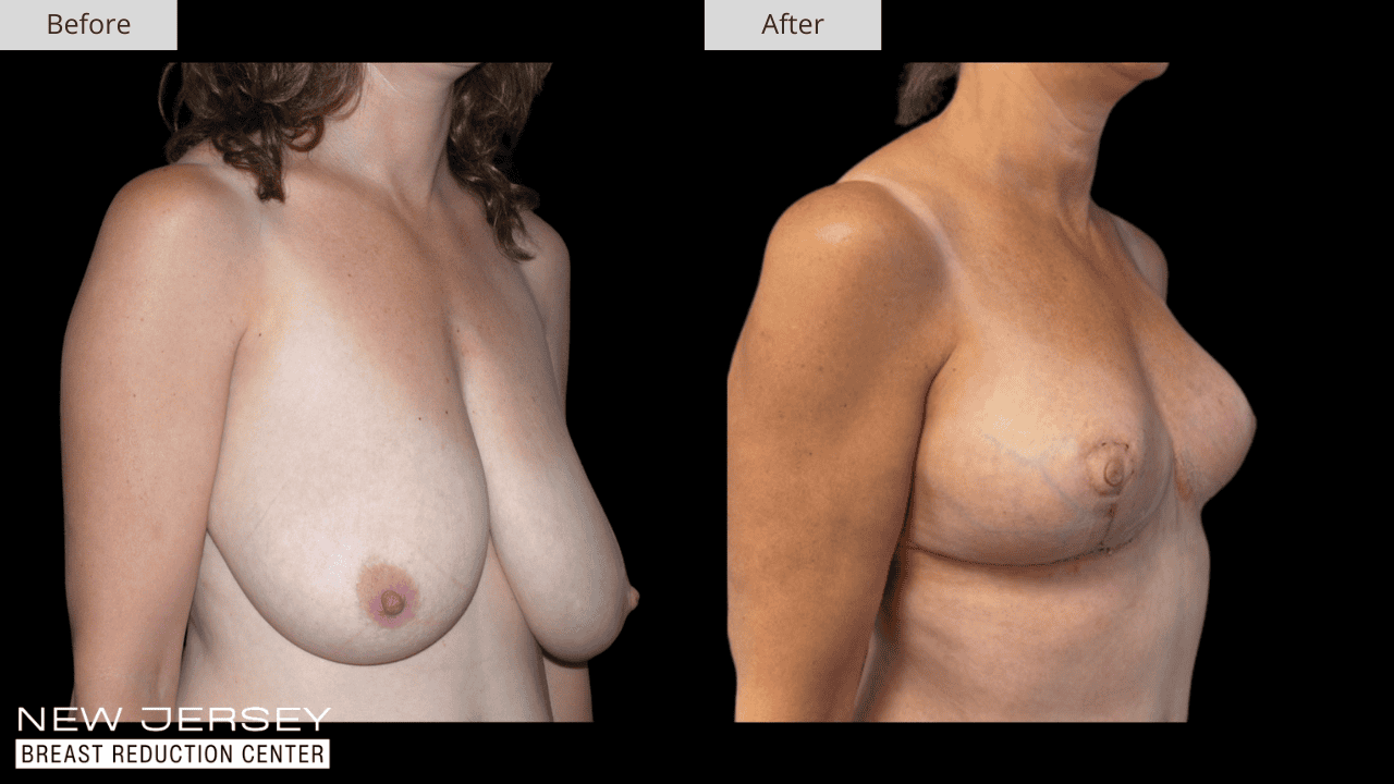 Breast Reduction New Jersey Before and After Patient #3