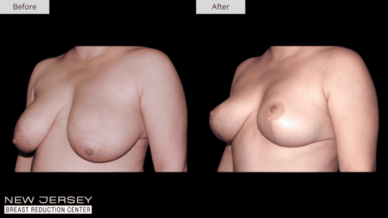 Breast Reduction New Jersey Before and After Patient #4
