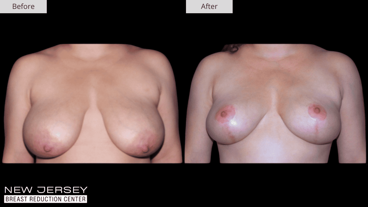Breast Reduction New Jersey Before and After Patient #4 Front