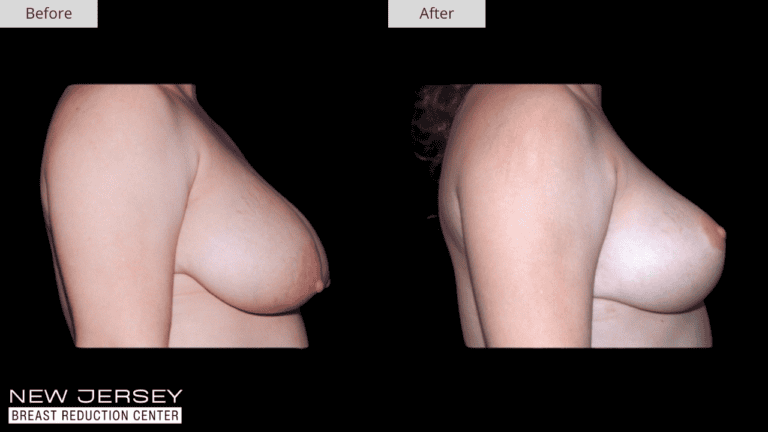 Breast Reduction New Jersey Before and After Patient #4 Side