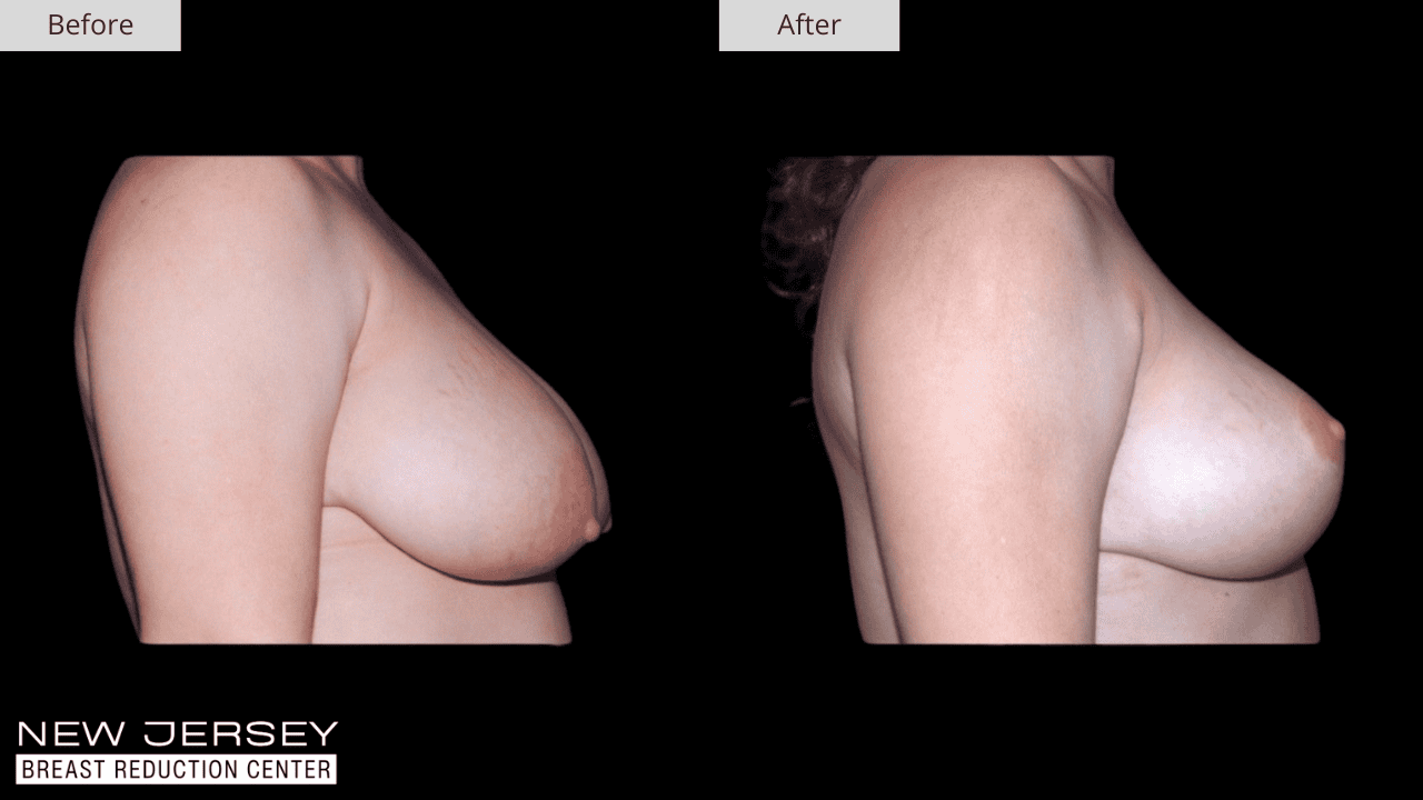 Breast Reduction New Jersey Before and After Patient #4 Side