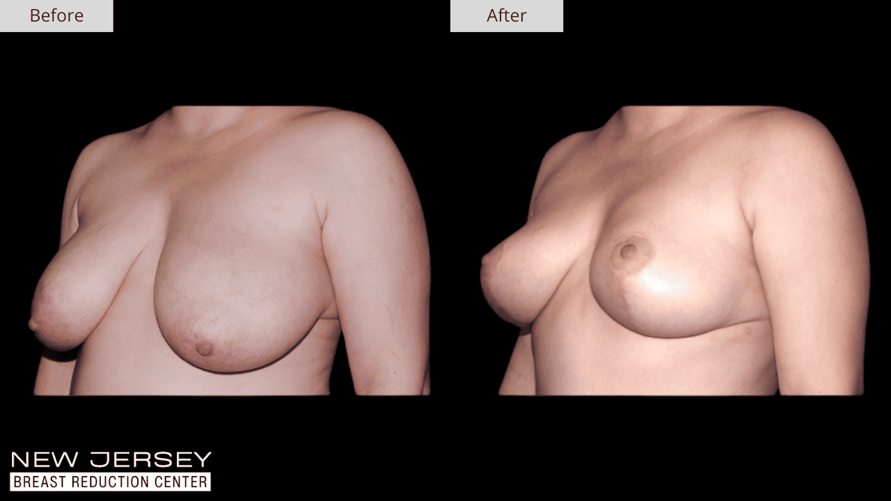 Breast Reduction New Jersey Before and After Patient #4