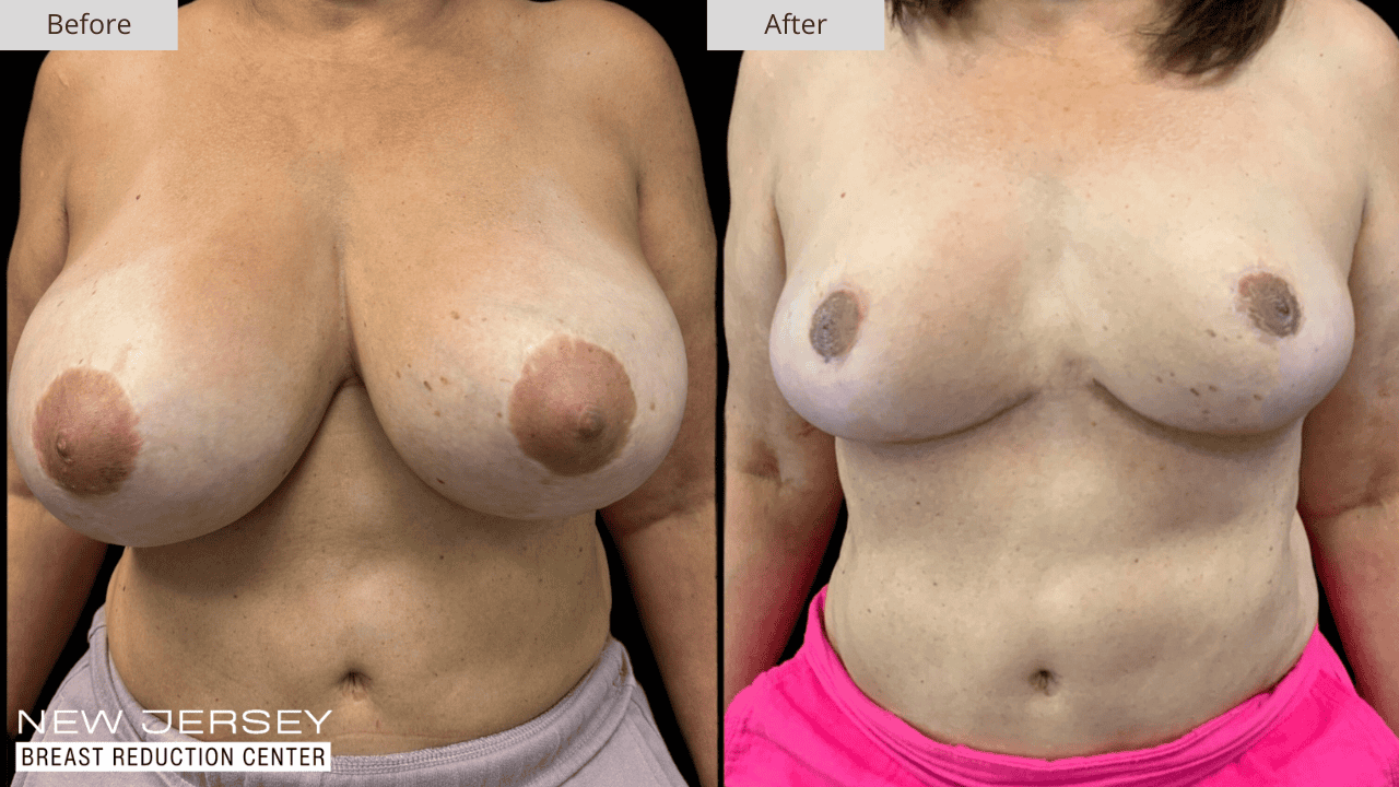 Breast Reduction New Jersey Before and After Patient #5 Front