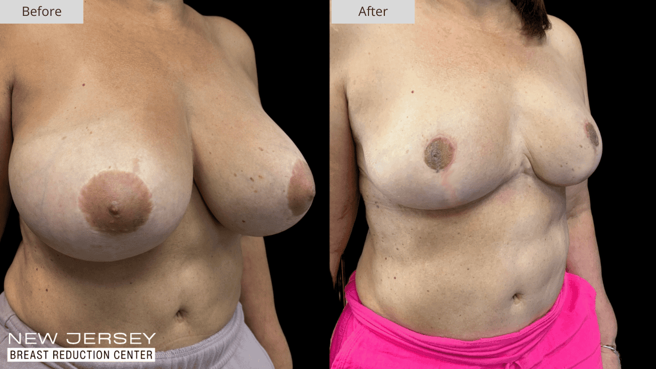 Breast Reduction New Jersey Before and After Patient #5