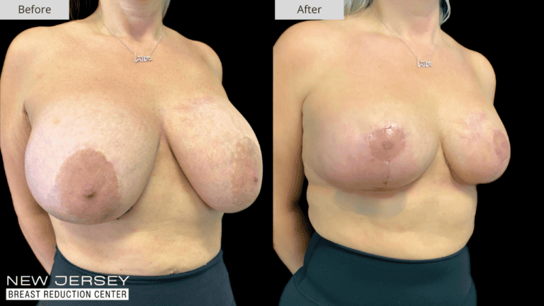 Breast Reduction New Jersey Before and After Patient #7