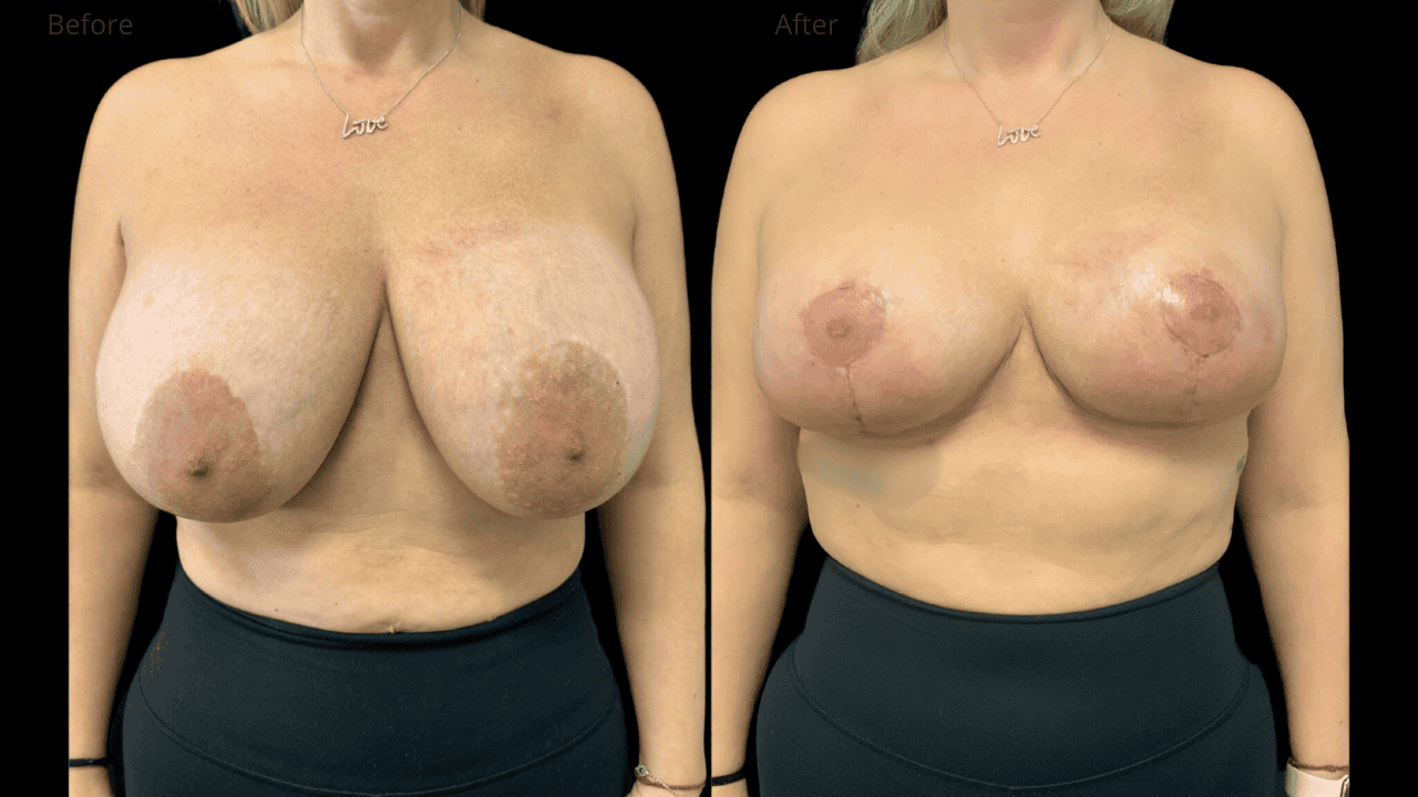 Breast Reduction New Jersey Before and After Patient #7 Front