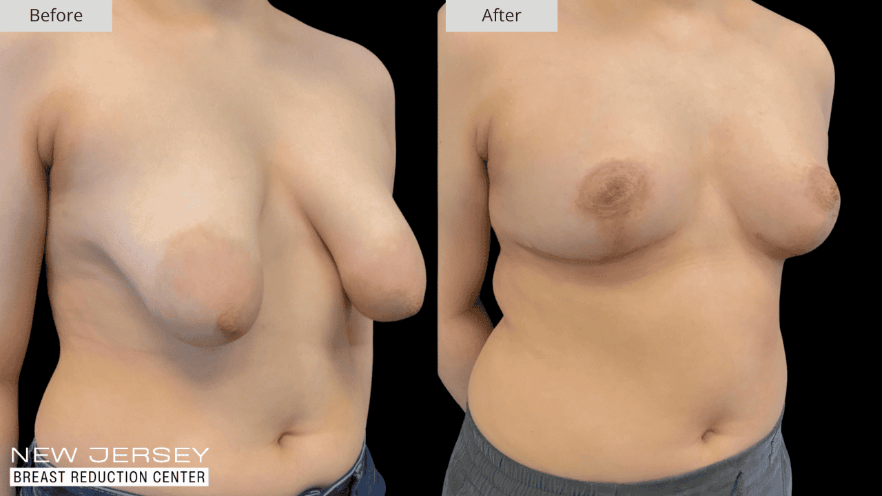 Breast Reduction New Jersey Before and After Patient #8