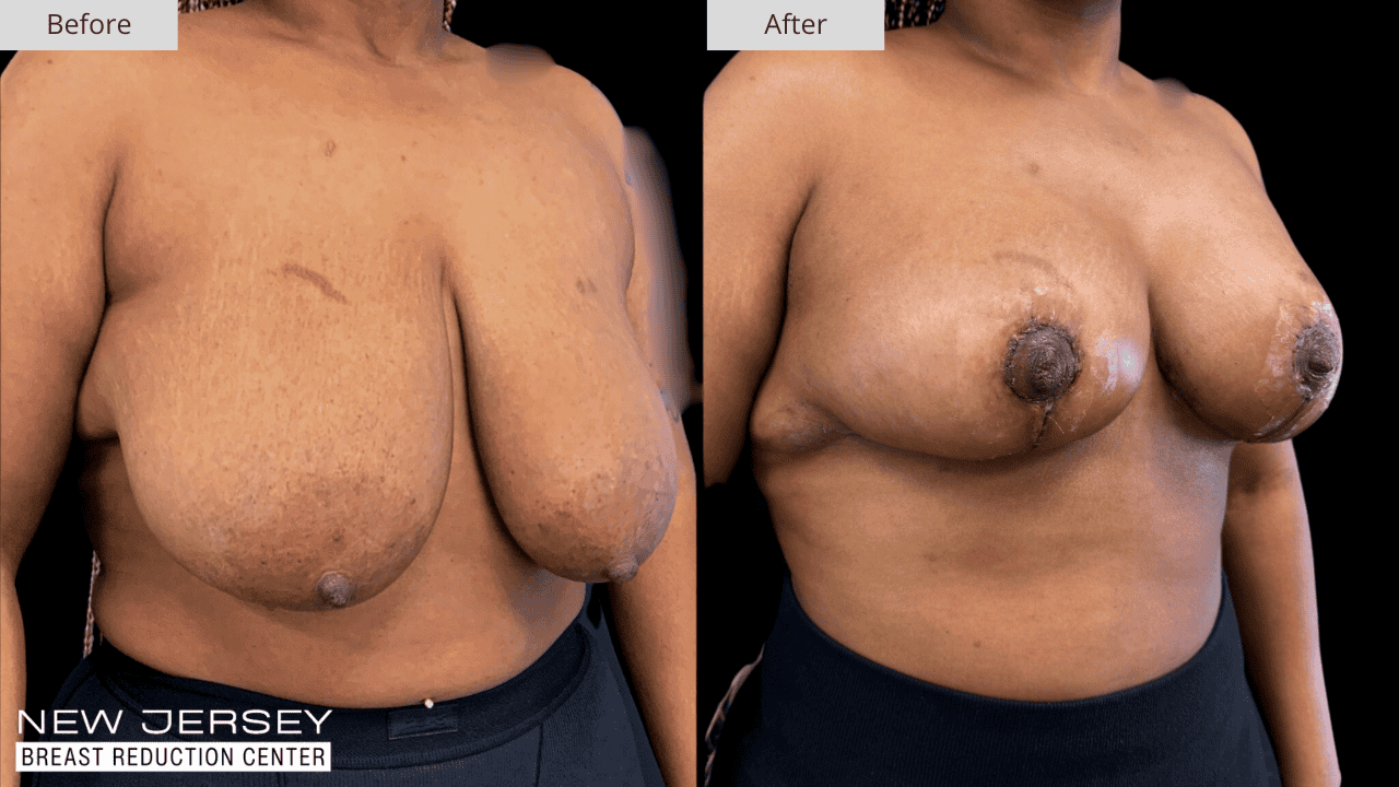 Breast Reduction New Jersey Before and After Patient #9