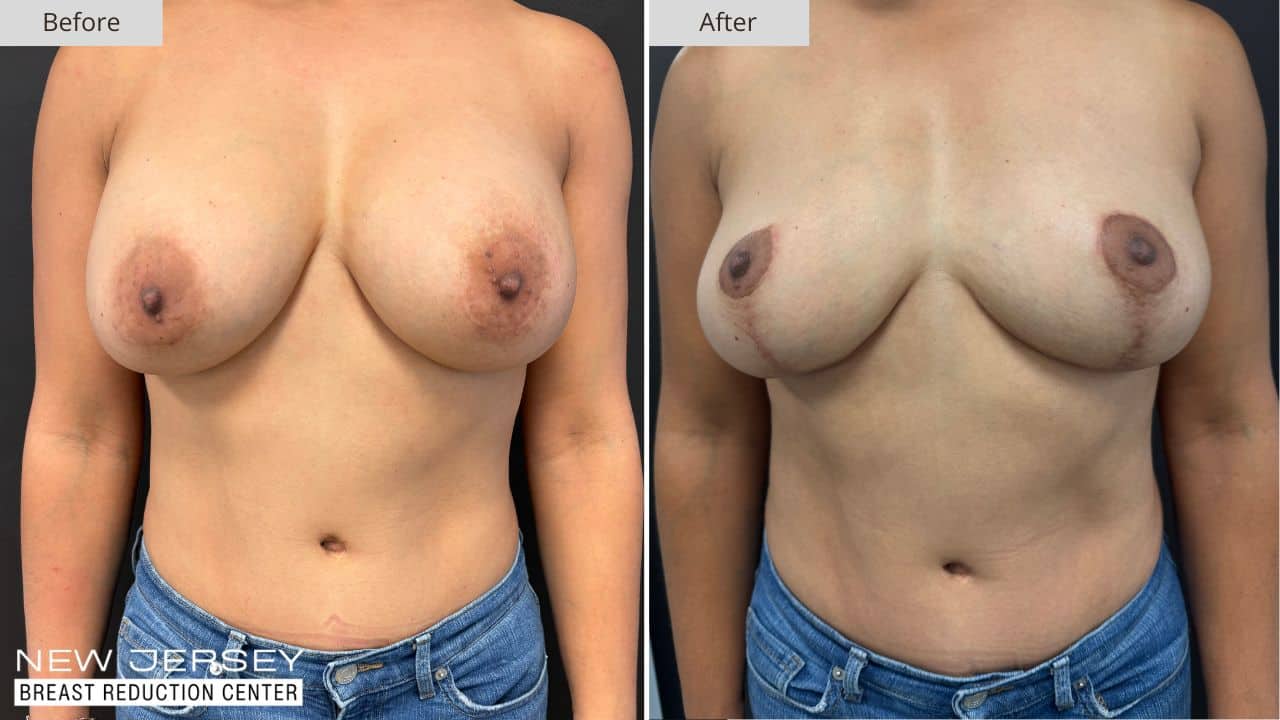 NJ Breast Reduction Center Before & After - Patient 109A