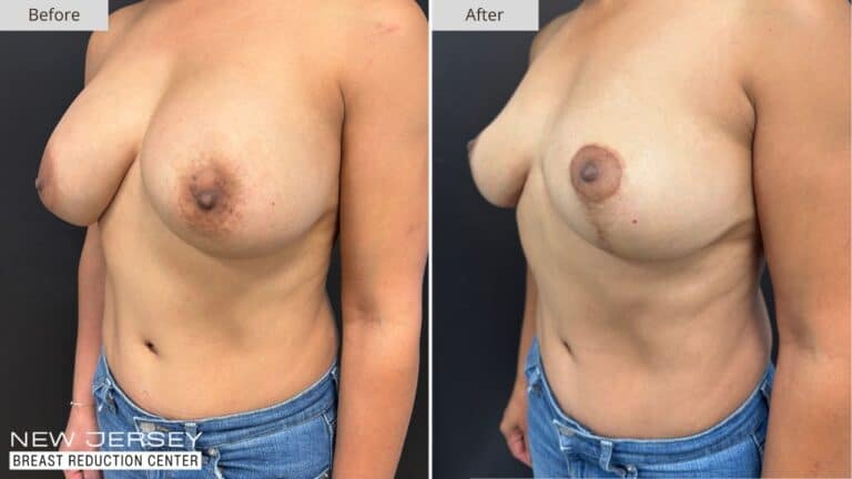 NJ Breast Reduction Center Before & After - Patient 109B