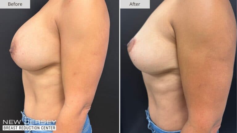 NJ Breast Reduction Center Before & After - Patient 109C