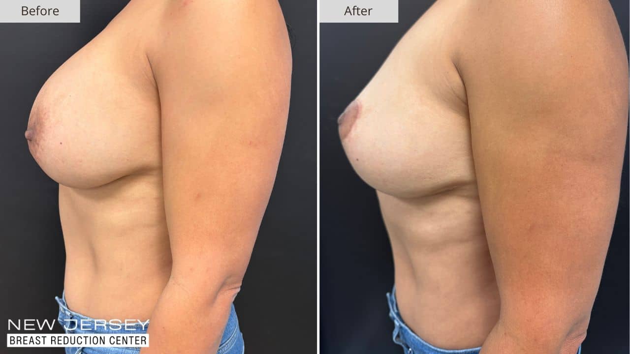 NJ Breast Reduction Center Before & After - Patient 109C