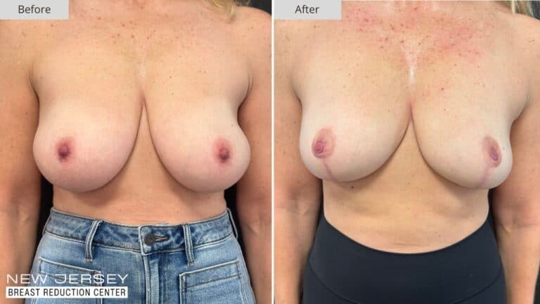 NJ Breast Reduction Center Before & After - Patient 110A