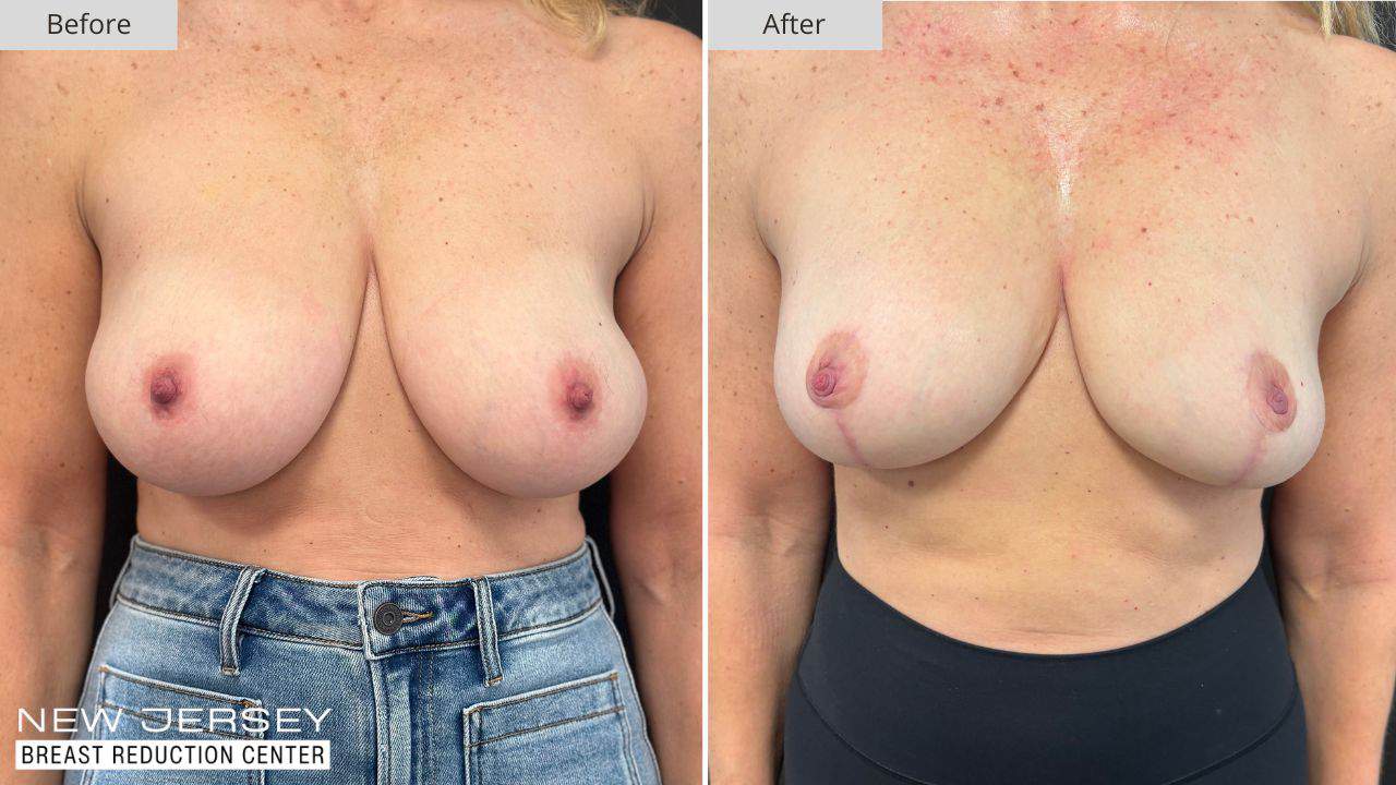 NJ Breast Reduction Center Before & After - Patient 110A