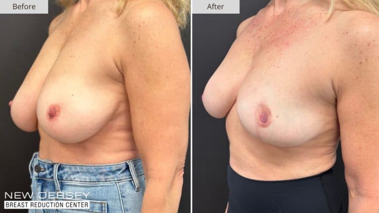 NJ Breast Reduction Center Before & After - Patient 110B