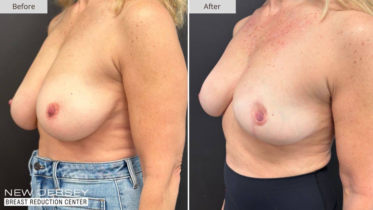 NJ Breast Reduction Center Before & After - Patient 110B