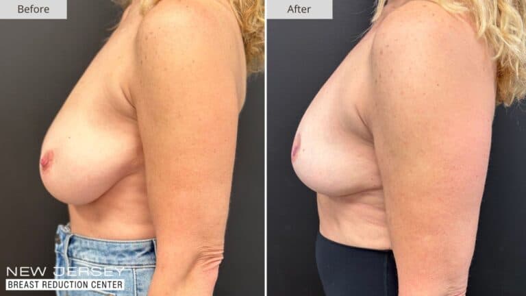 NJ Breast Reduction Center Before & After - Patient 110C