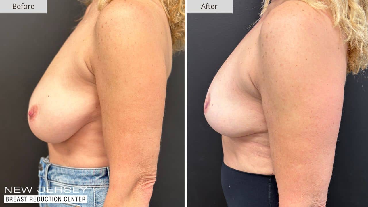 NJ Breast Reduction Center Before & After - Patient 110C