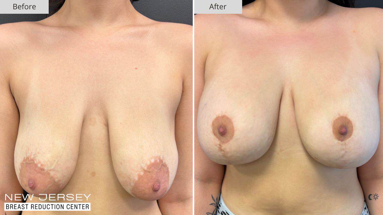 NJ Breast Reduction Center Before & After - Patient 112A