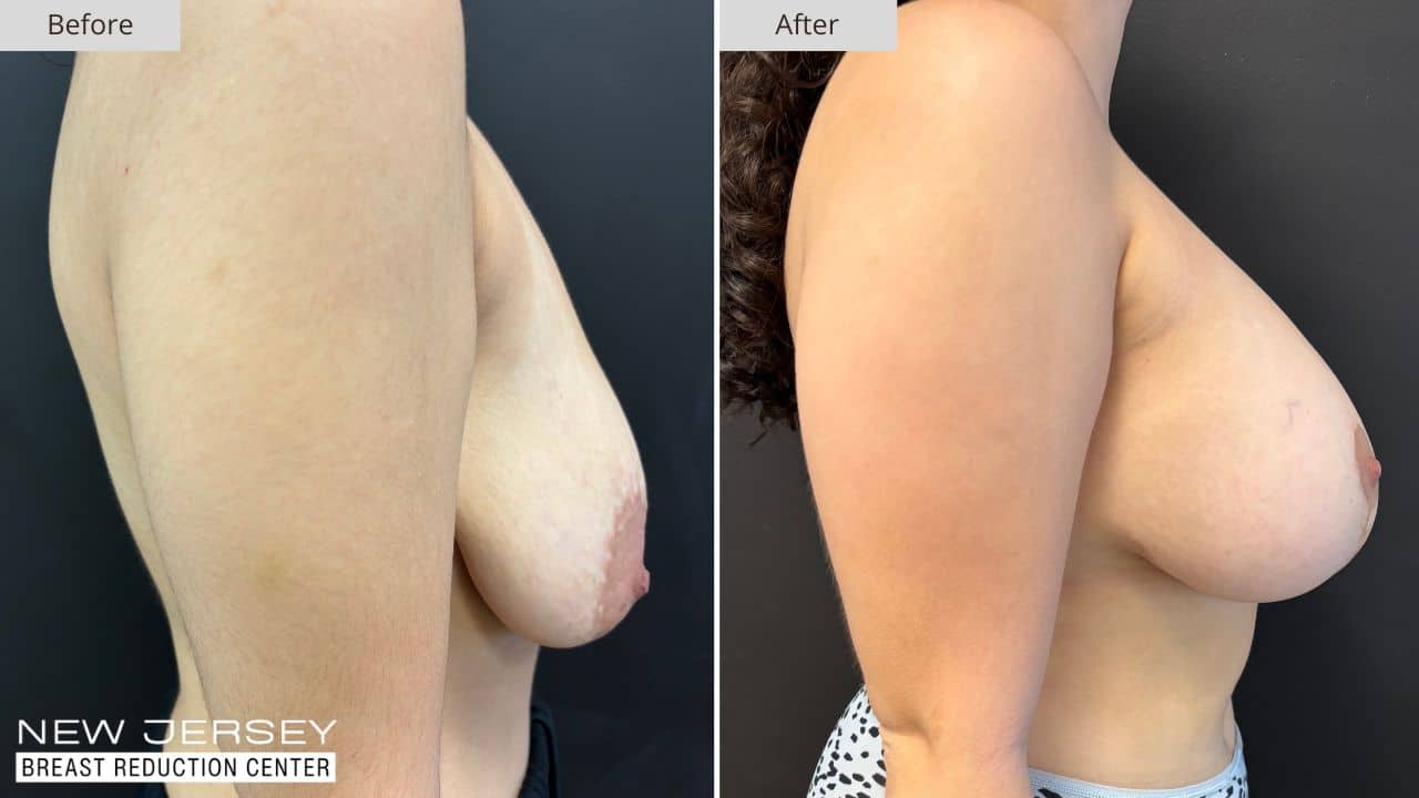 NJ Breast Reduction Center Before & After - Patient 112B