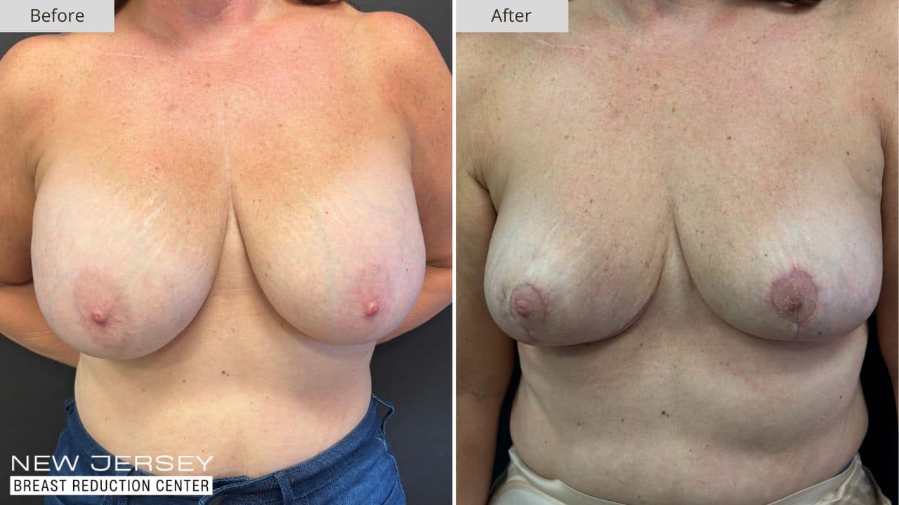 NJ Breast Reduction Center Before & After - Patient 113A