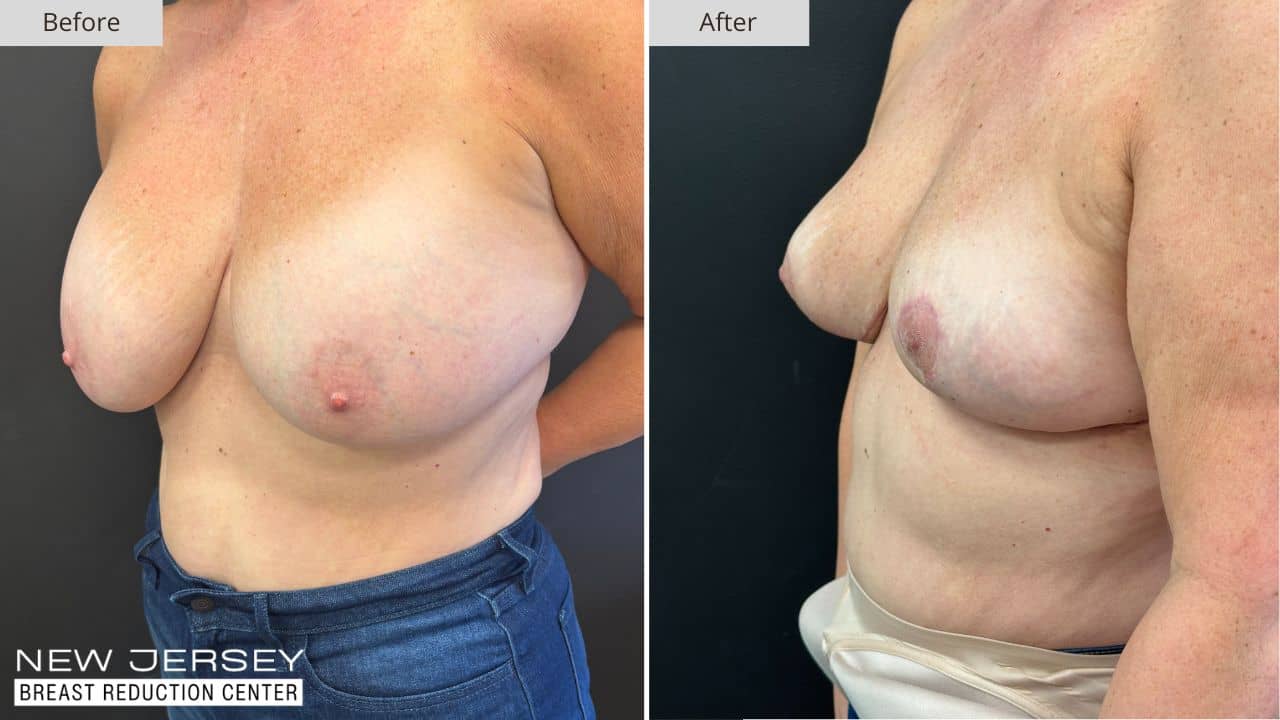 NJ Breast Reduction Center Before & After - Patient 113B