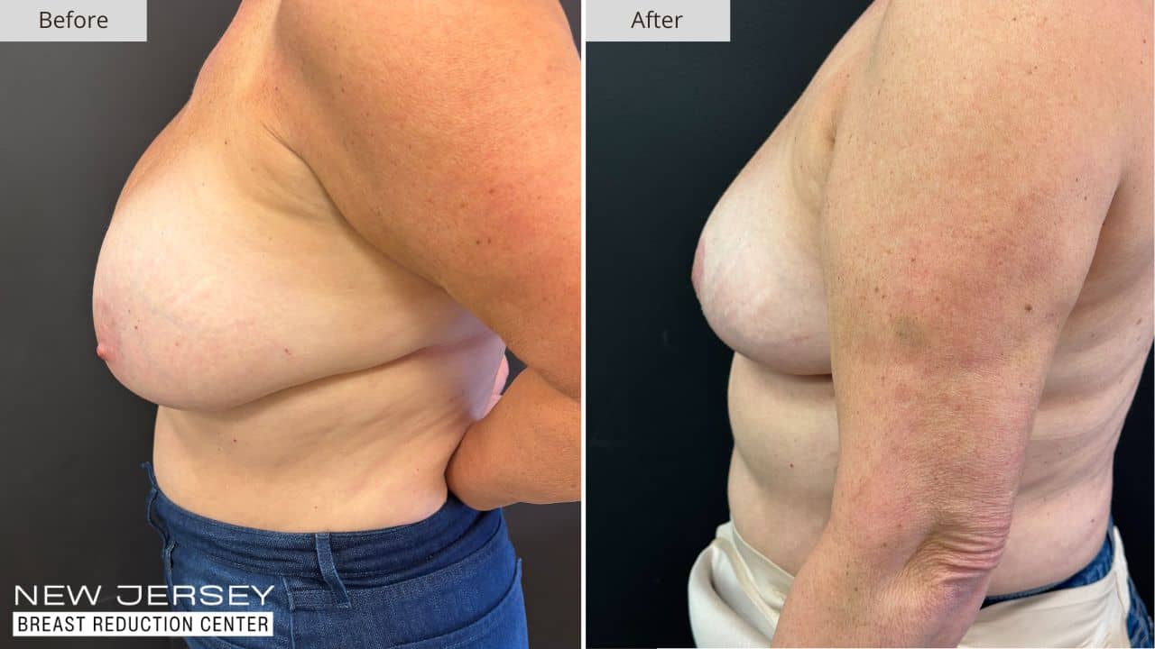 NJ Breast Reduction Center Before & After - Patient 113C