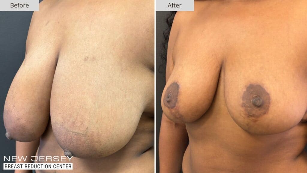 New Jersey Breast Reduction Before & After