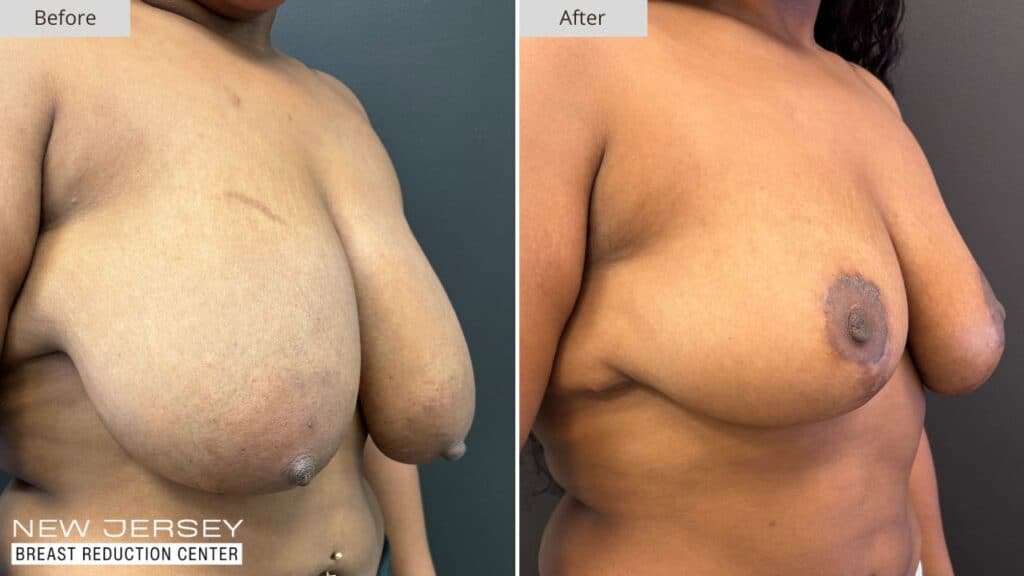 New Jersey Breast Reduction Before & After