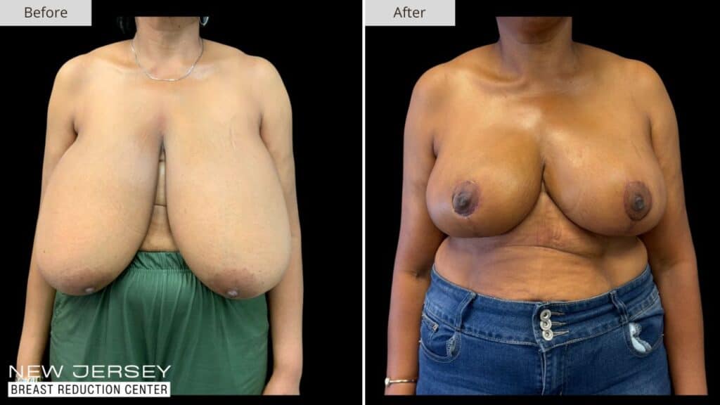 New Jersey Breast Reduction Before & After
