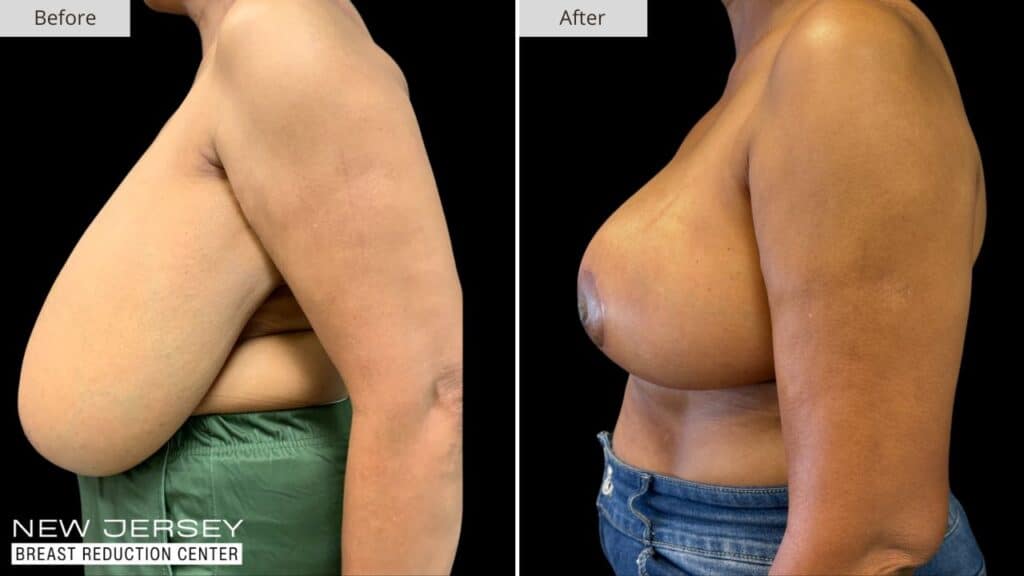 New Jersey Breast Reduction Before & After