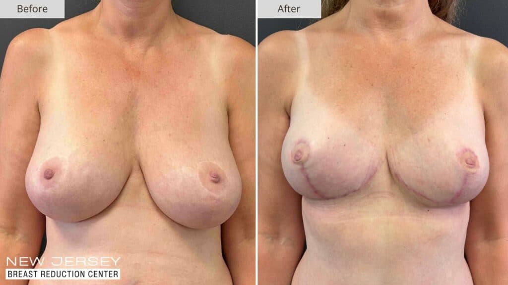 New Jersey Breast Reduction Before & After