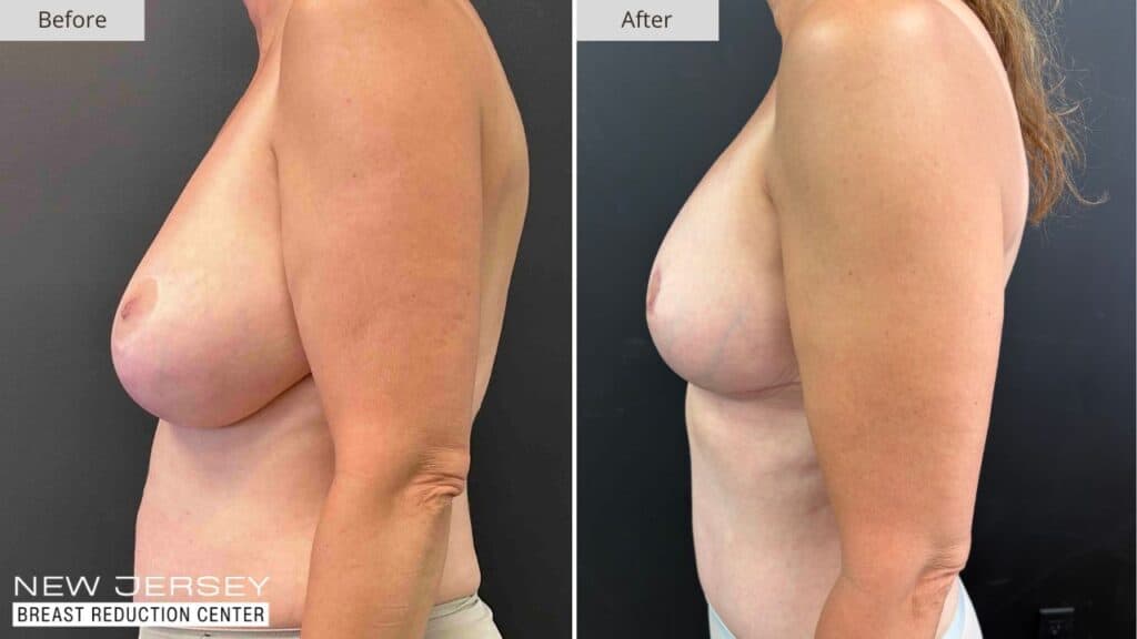 New Jersey Breast Reduction Before & After