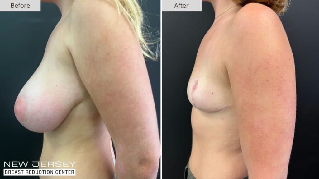 New Jersey Breast Reduction Before & After