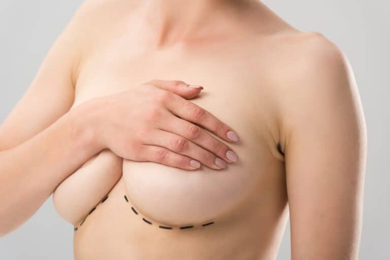 partial view of woman with marks under breasts