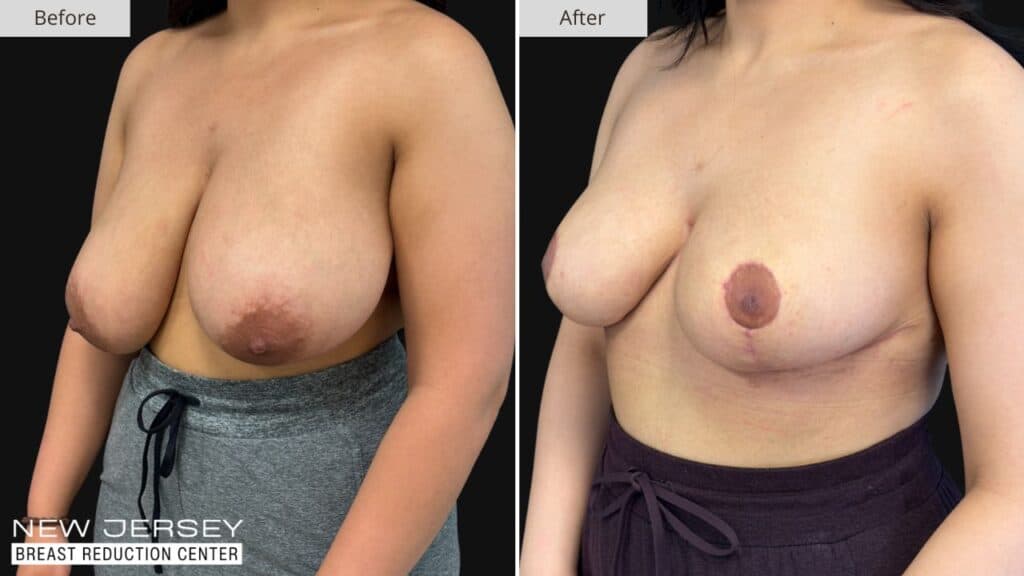 New Jersey Breast Reduction Before & After
