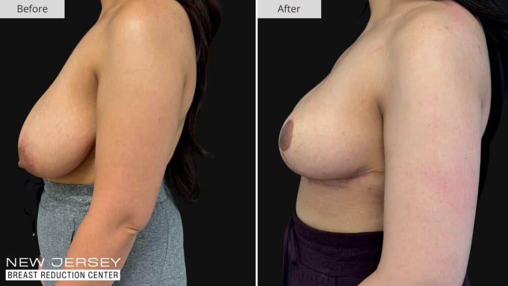 New Jersey Breast Reduction Before & After